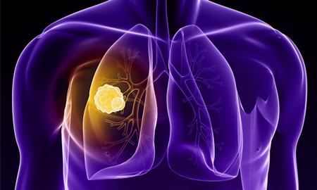 非小细胞肺癌靶向药物吉泰瑞阿法替尼，印度的阿法替尼在哪买被列入各省医疗保险！