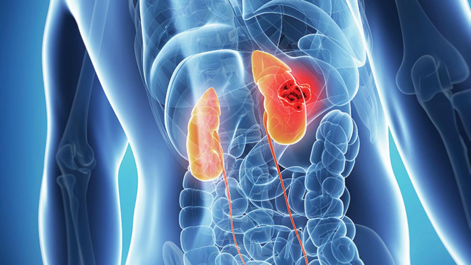 NEJM:PD L1替尼协同阿西替尼有希望变成末期肝癌的规范治疗法！