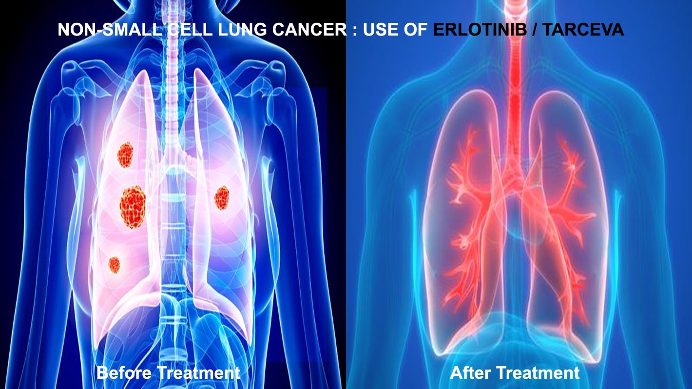 一线医治EGFR基因突变肺癌，厄洛替尼靶向药价格雷莫芦单抗协同厄洛替尼治疗法获FDA准许