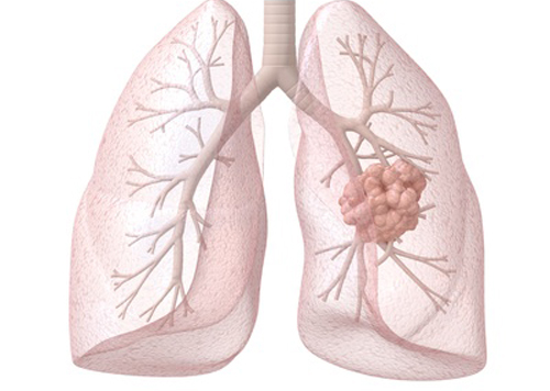 肺癌靶向药物易瑞沙，凯美纳易瑞沙减价三成