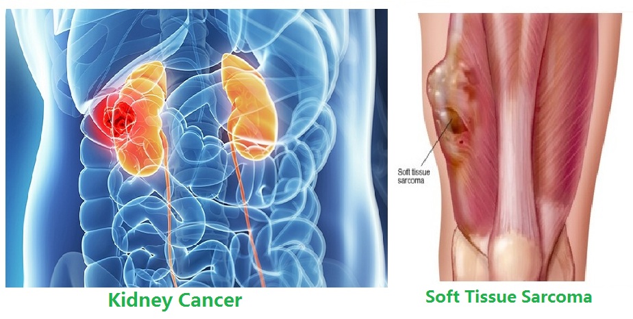 华印诊疗：帕唑帕尼靶向治疗对肿瘤转移软组织肉瘤的医治